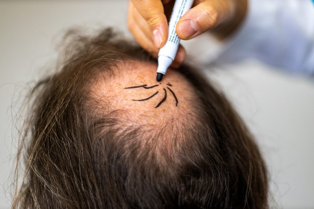 hair transplant cost turkey